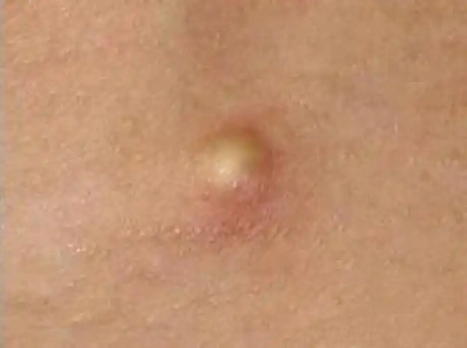 耳朵后边的皮脂腺囊肿图片