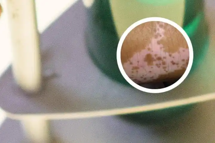 肛周白斑的初期图片