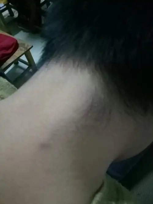 颈的后面有一小块豆豆一样的小硬块,几年了还不见消,什么情况?