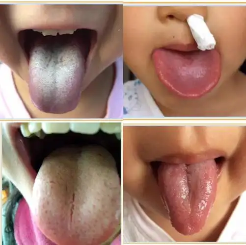 最全的儿童舌诊图,对号入坐