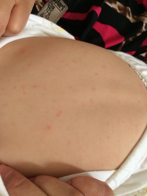 宝宝有些发烧,感冒,身上出了好多小红疙瘩