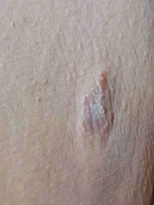 皮肤病,腹股沟长了块癣