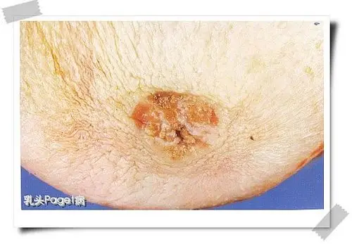乳头表面溃烂,周围皮肤呈桔皮样外观.