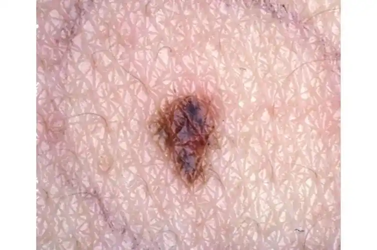 激光会使痣恶变吗?