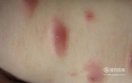 螨虫叮咬后的症状图