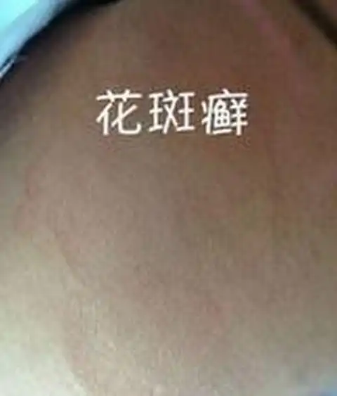 药物微波渗透疗法治花斑癣