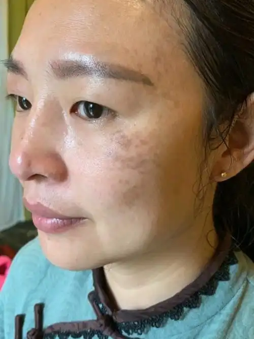 老顾客介绍过来的真皮斑,期待她的脱变吧.