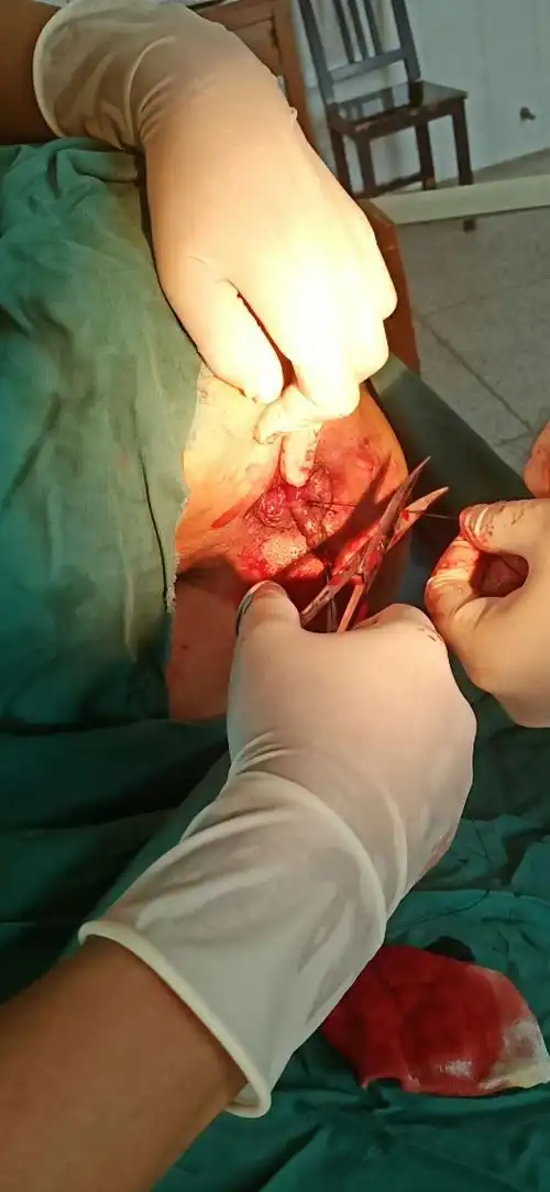 较大混合痔外剥内扎术