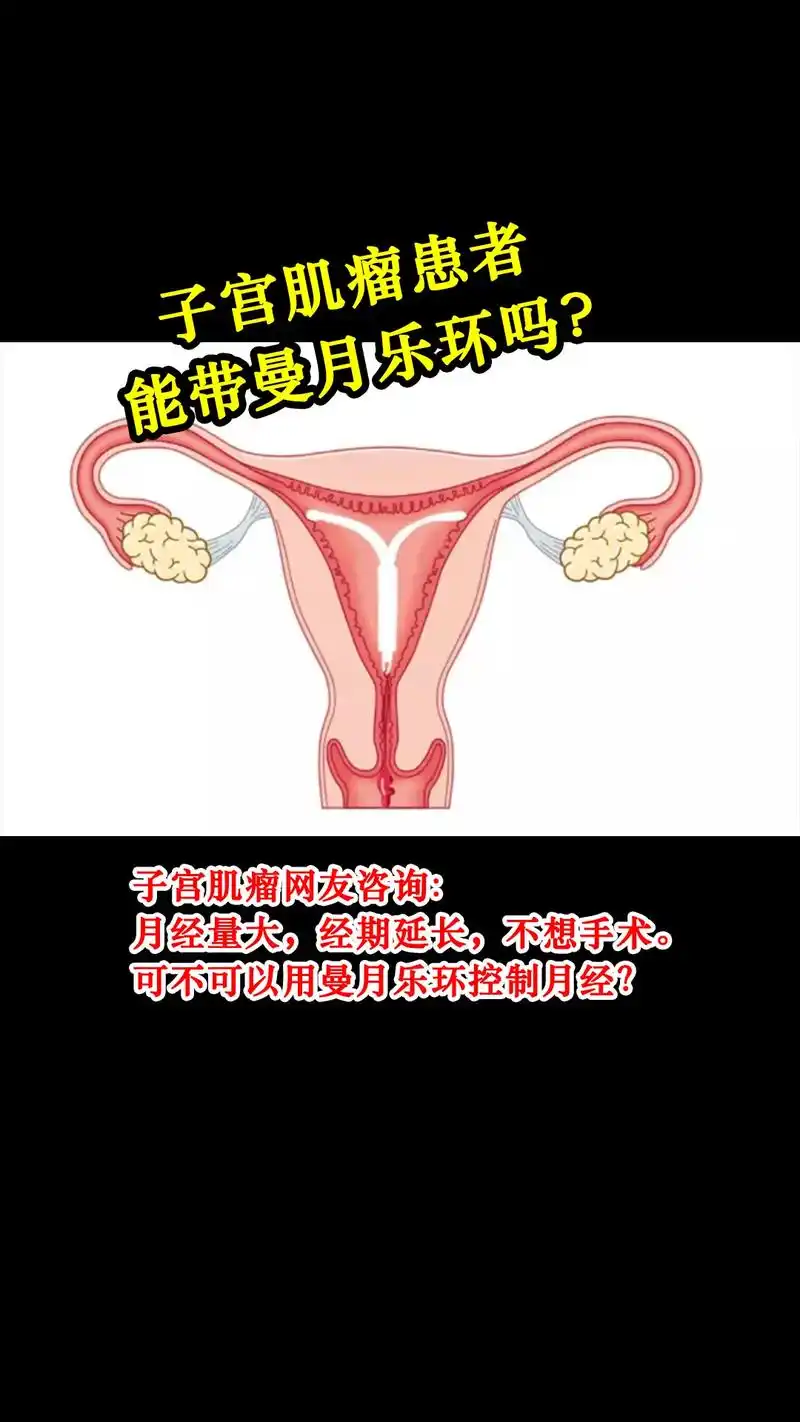 子宫肌瘤患者,可不可以带曼月乐环.前些天有网友咨询我说,大夫 - 抖音