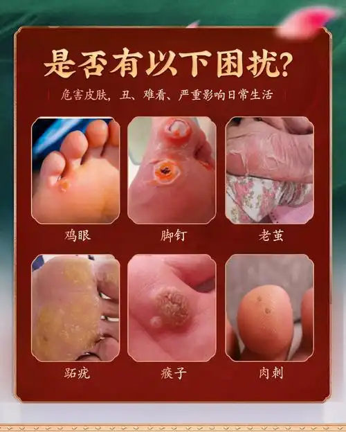 祛脚长死皮膏鸡眼贴跖疣寻常疣脚垫趾疣瘊子肉刺贴鸡眼膏手部足部1659
