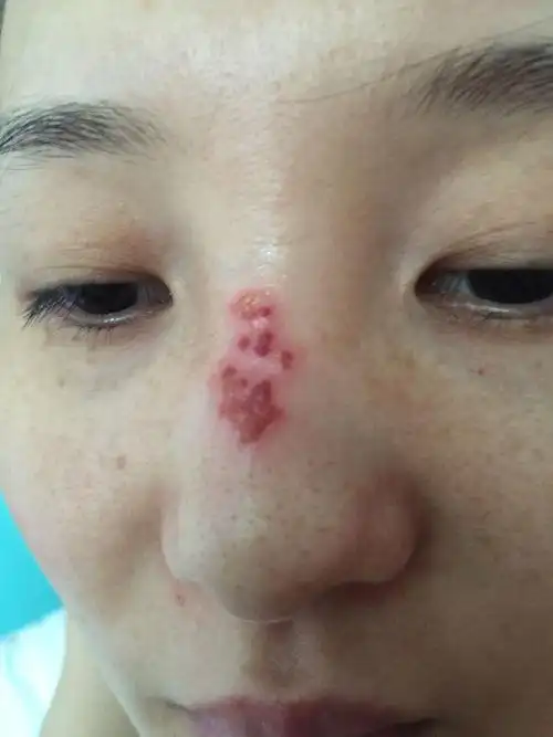 请问这个是被什么虫子咬的一开始只是几个小红点有点痒后来就开始越来