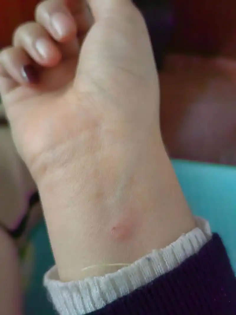 虱子叮咬后?怎么办?