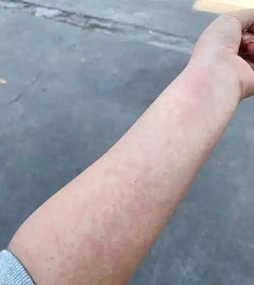 太不容易了,终于找到这个方法把顽固的湿疹搞定了_皮肤_症状_患者