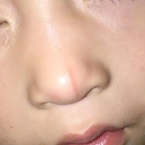 宝宝被别的小朋友推了一下嗑在了水井盖上的不锈钢上,鼻子上嘴巴上像