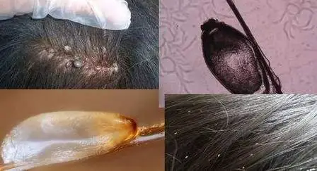 头上长虱子怎么去除 去虱子和虱子卵的有效方法