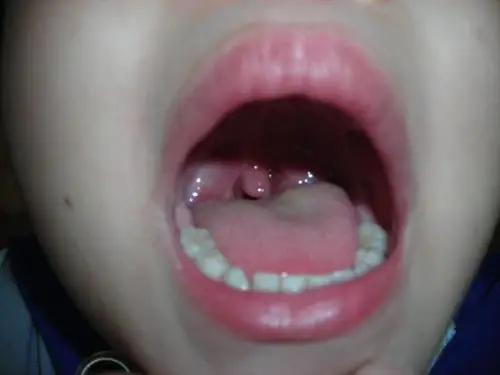 扁桃体肿大图片50