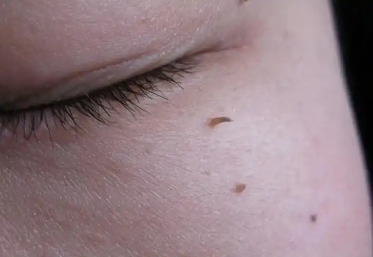 初期小疣体图片 疣体早期症状图片-春风号