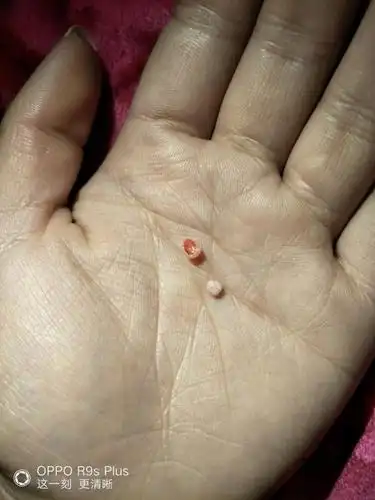 疙瘩里面挤出来的是什么东西