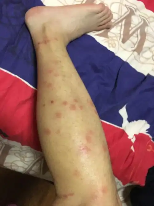 腿上被咬了几十个包,不知道是家里闹跳蚤还是在外面被蚊子叮咬的 希