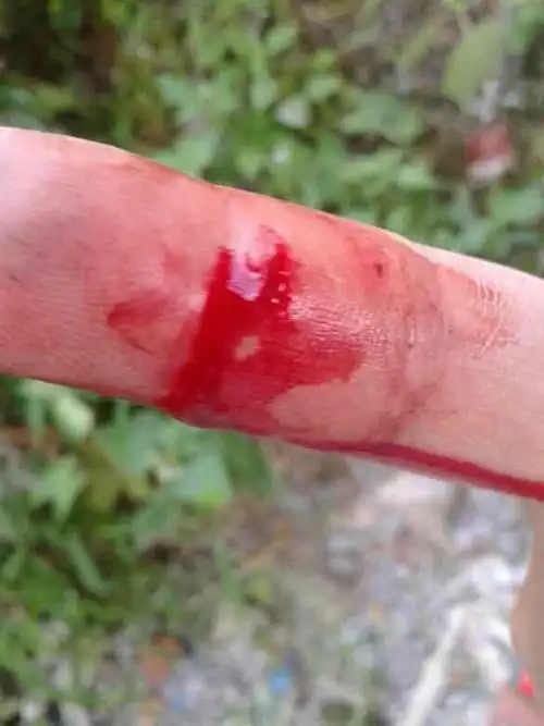 手割伤怎样才能报销 手被刀割伤了可以报意外险吗