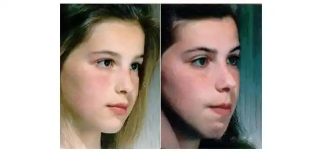 腺样体面容几岁定型应该怎么训练治疗