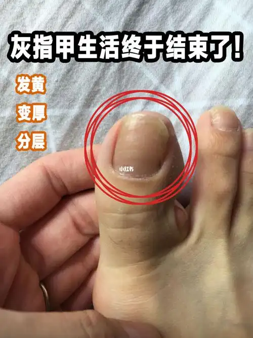 发黄分层的灰指甲祛除了!亲身分享!