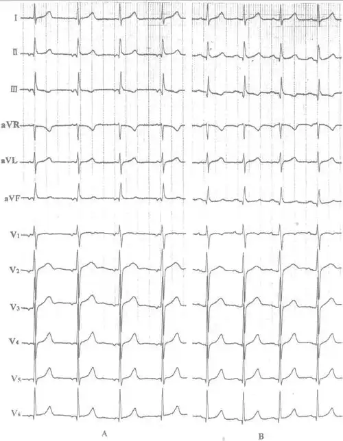 这是心电图上较为常见的一种主动性房性心律失常.