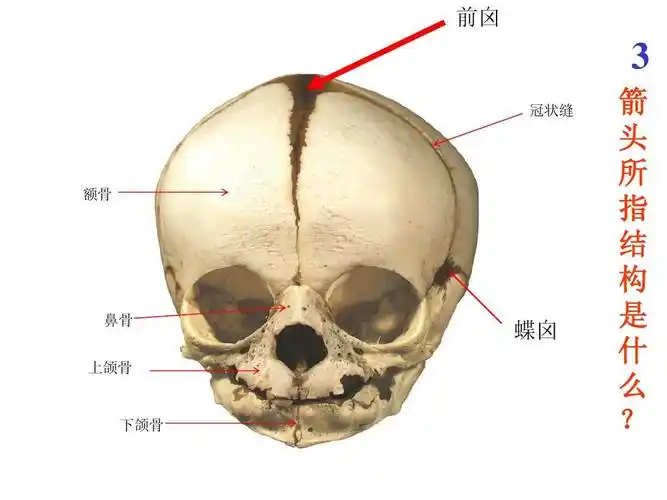 前囟 3 冠状缝 额骨 鼻骨 上颌骨 蝶囟 下颌骨 箭 头 所 指 结 构