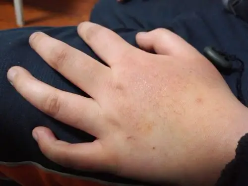请教各位手背上的是湿疹吗