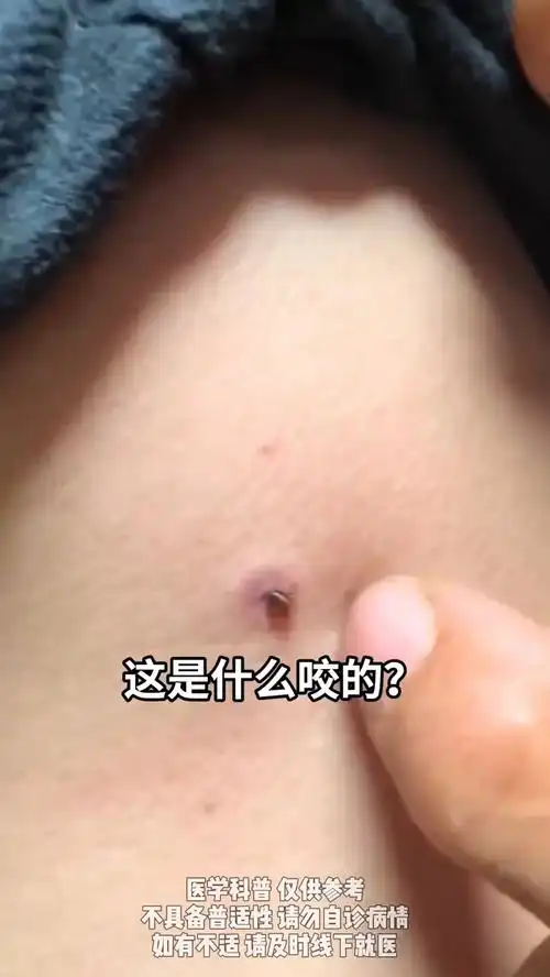 不同虫子叮咬的表现,你都知道吗? 蚊虫叮咬