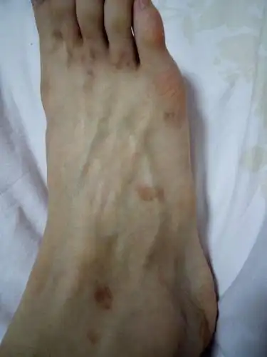 脚背有好多红斑,不疼不痒的,是怎么回事呀?