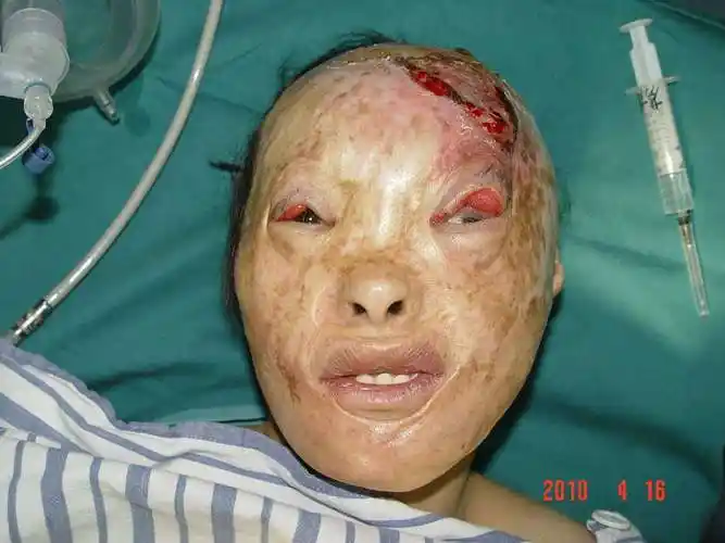 陈旧性烧伤疤痕需防止变异(1) - 好大夫在线