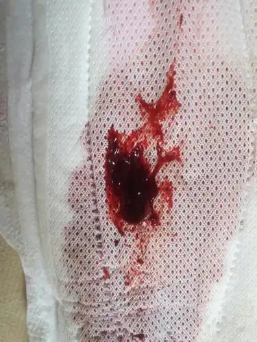 为什么我来大姨妈有一块红色?