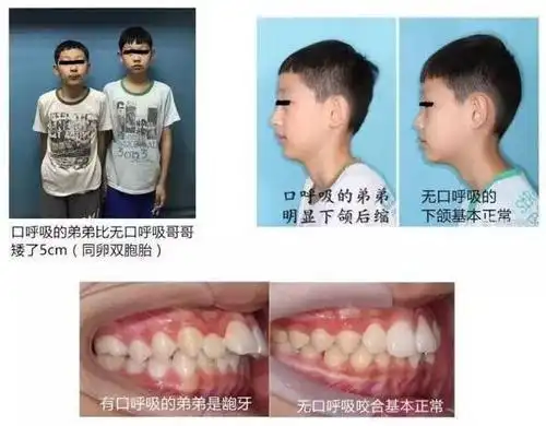 腺样体对比图由古草世家提供参考