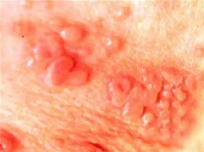 女性假性湿疣