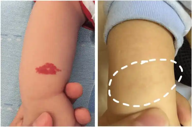 新手妈妈警惕8090的血管瘤是在新生儿出生后一周左右长出的