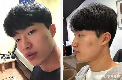 男生塌鼻改善案例,气质挺鼻原来是这样来的!