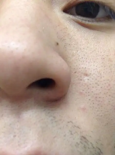 脸上密密麻麻这是黑头吗 怎么去除?