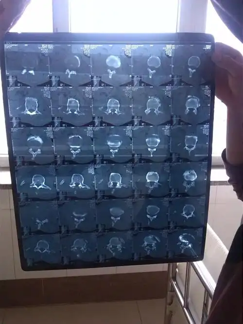 腰椎骨折的片子能看出神经损伤情况吗.如果能请看一下神经损伤情况