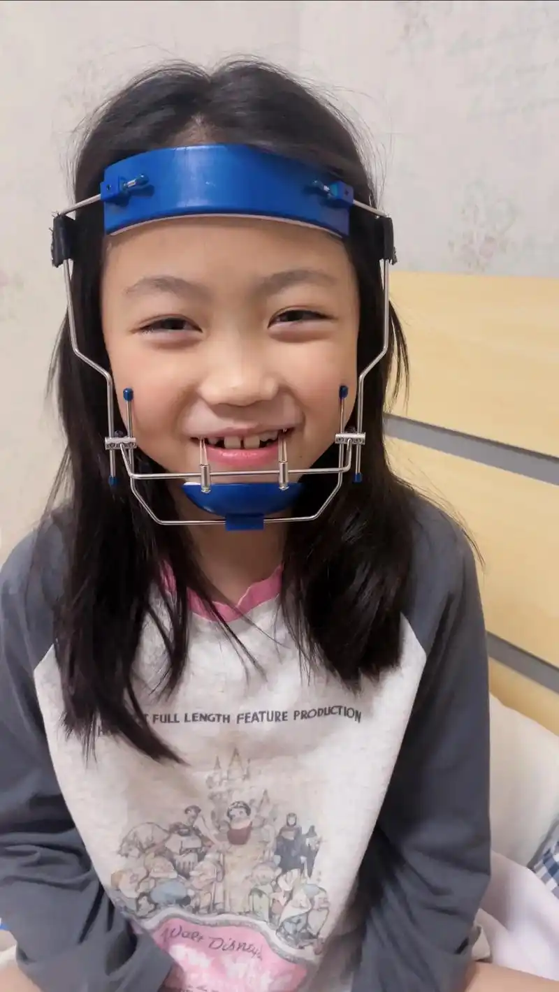 反颌矫正.经历了腺样体扁桃体切除,多生牙拔牙,牙齿矫正,现在 - 抖音