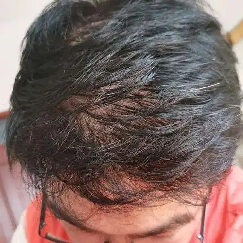 头顶的头发越来越稀疏,能不能去做植发呢?