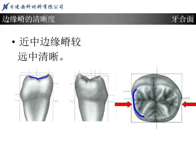 边缘嵴的清晰度 牙合面   近中边缘嵴较 远中清晰.