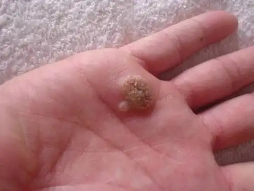 轻松去除瘊子大蒜帮到你