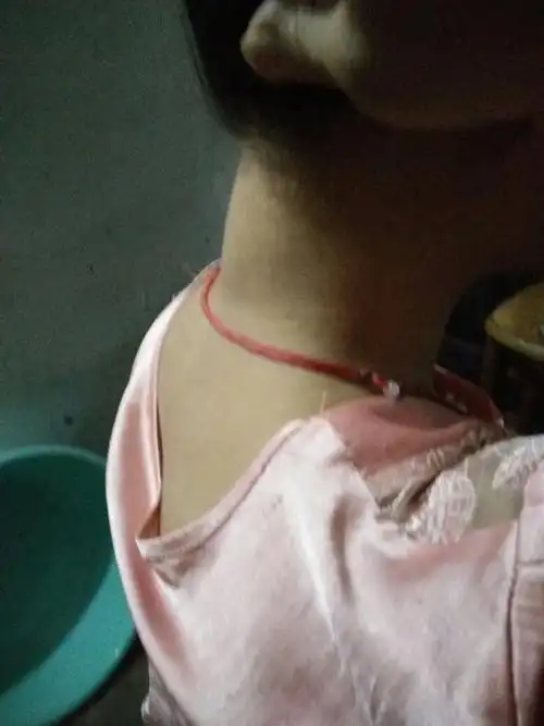 今天早上梳头发的时候,老公看见我脖子后面有点凸出,就问我脖子后面是