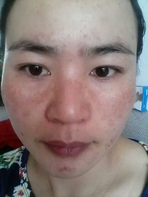 香港黄褐斑专家_香港治疗黄褐斑哪个专家好_香港治疗黄褐斑最好的专家