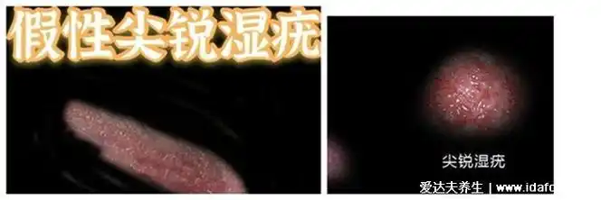 女性假疣和真疣的分别图片 一,尖锐湿疣