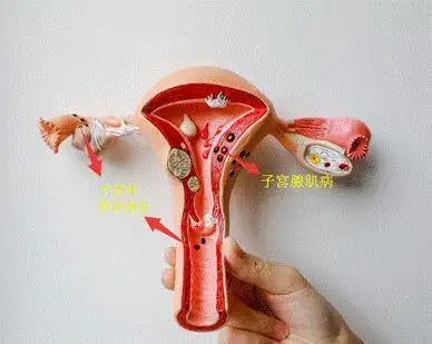 带曼月乐环后不规则出血怎么办?_子宫