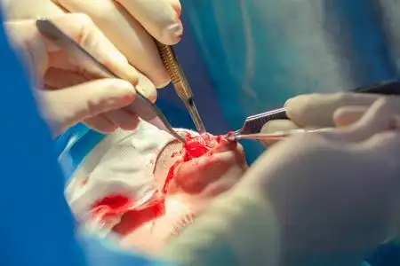 医美模特鼻子外科医生和他的助手在医院手术室做鼻子整容手术.