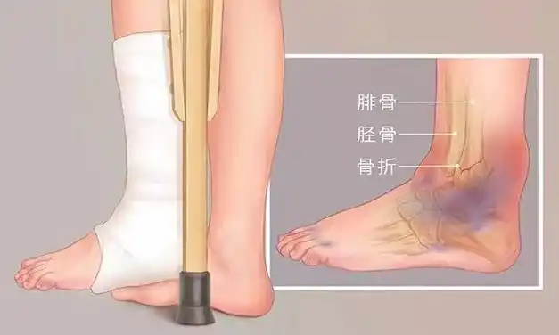 三踝骨折怎么办看看太原市迎泽区中医医院怎么做