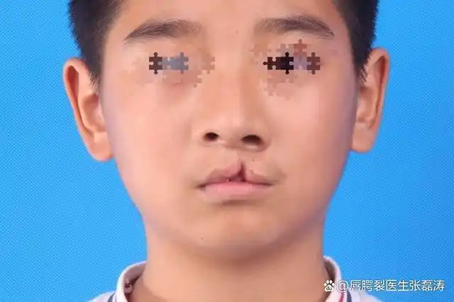 导语: 先天性唇腭裂是指上唇或上腭出现裂口的一种口腔颌面部的先天性